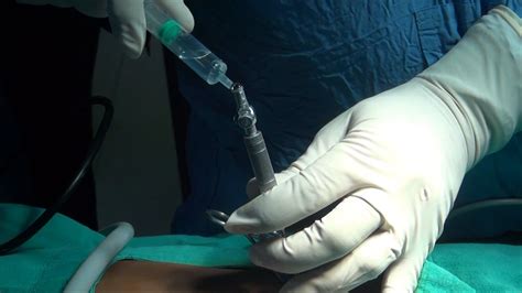 the needle drop testing|Abdominal Access technique .